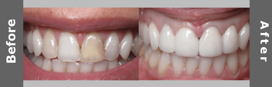 veneer before dental veneers teeth suter brook